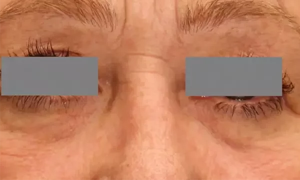 Periocular area — 6 weeks