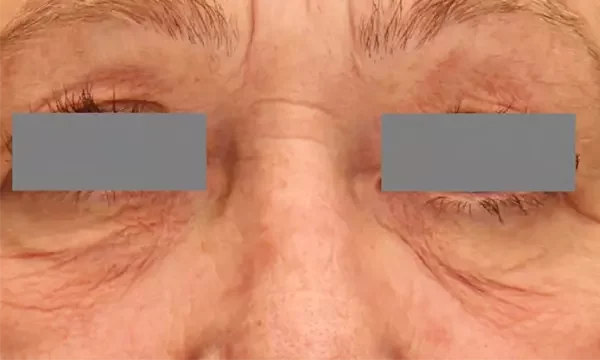 Periocular area — baseline
