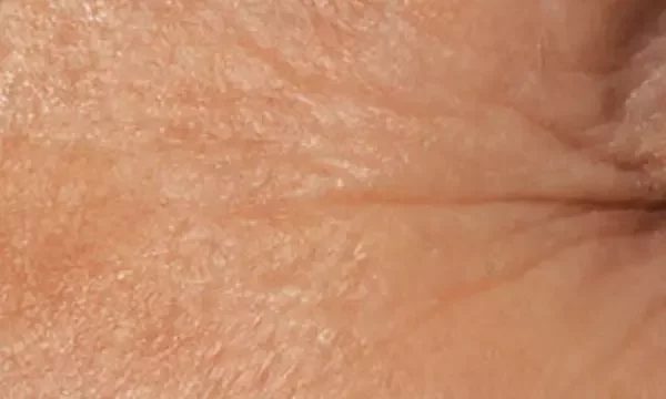 Crow's feet — 6 weeks