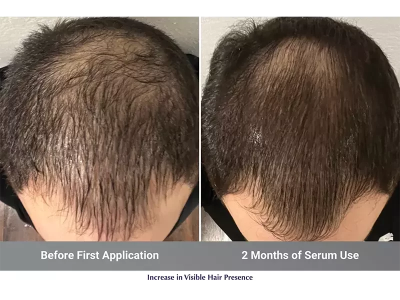 Hair presence — baseline and Day 84