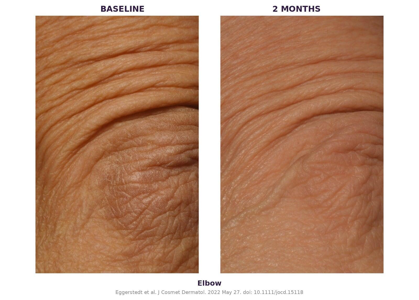 Elbow — 6-week results