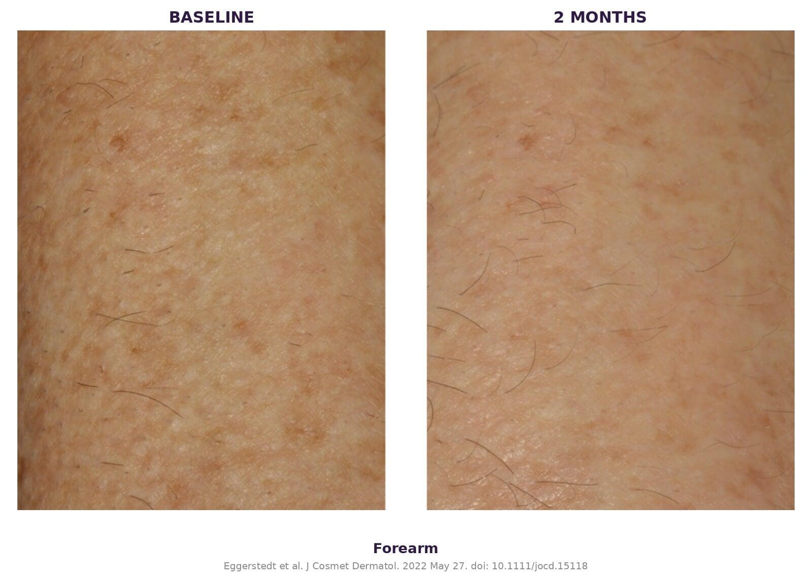 Forearm — 6-week results