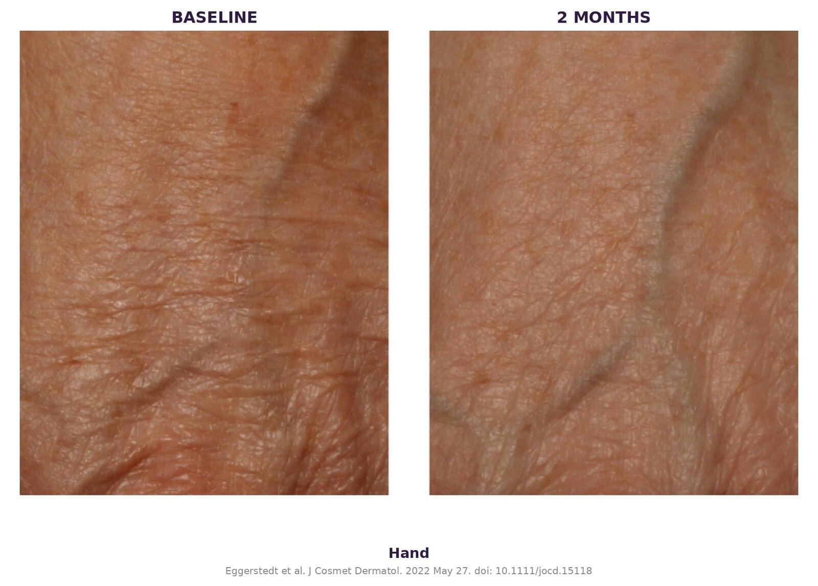 Hand — 6-week results
