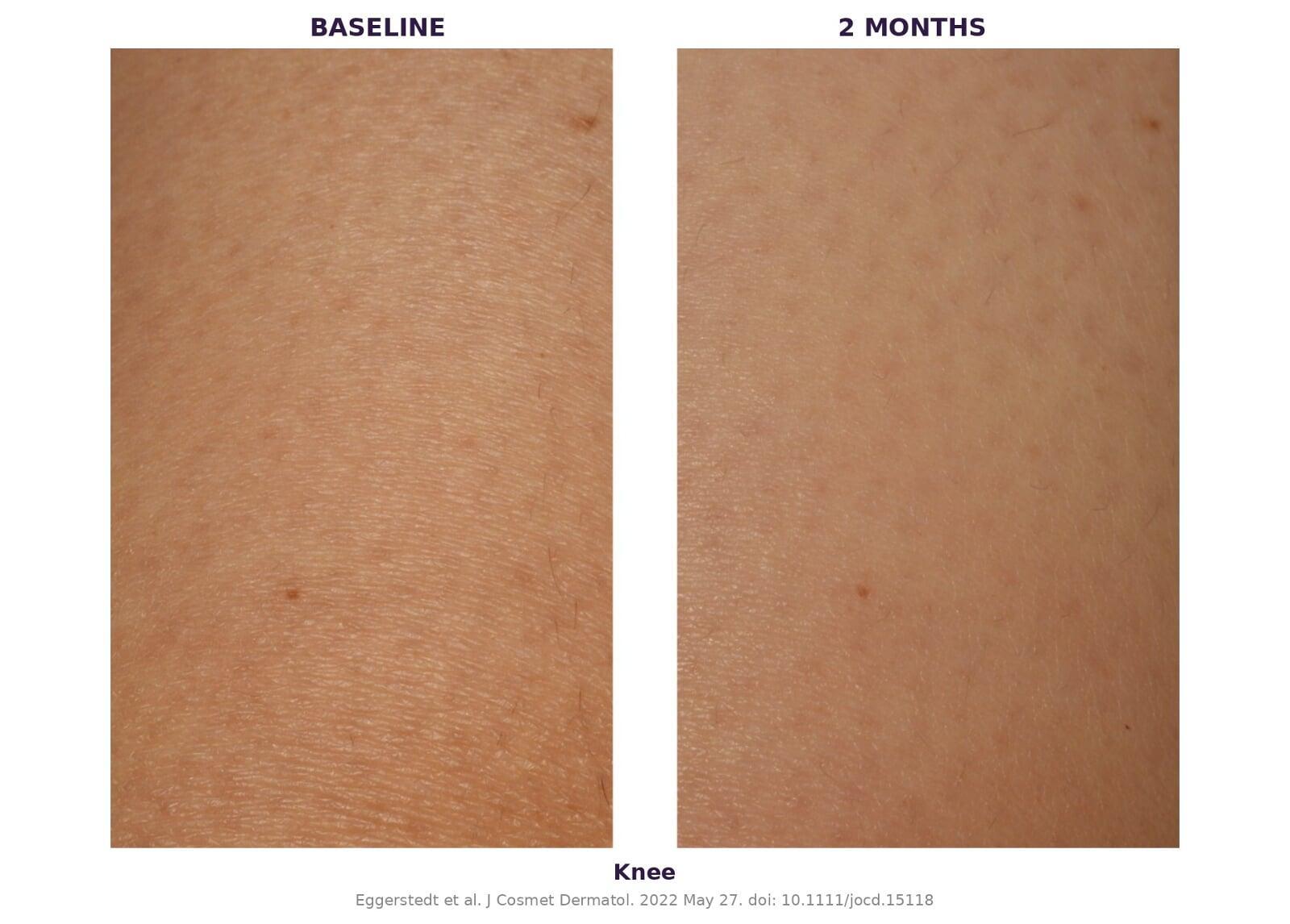 Knee — 6-week results